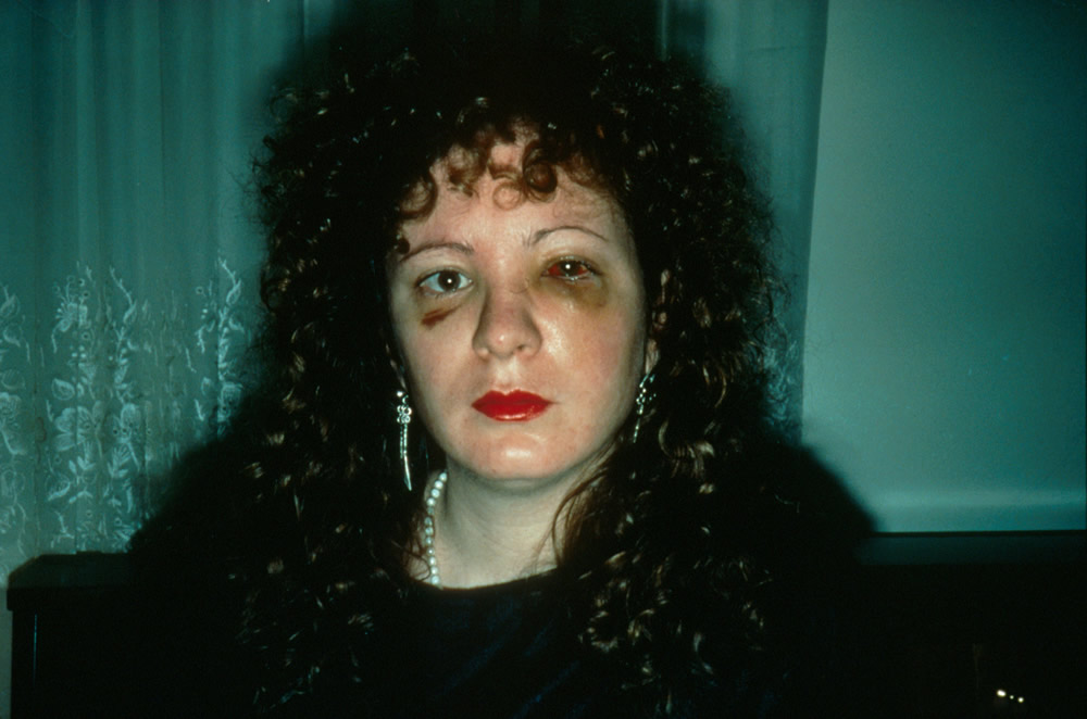 Recordações em registro - Nan One Month After Being Battered, 1984 (Foto: Nan Goldin)