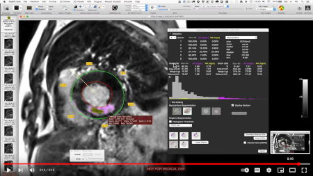 Infarct size quantification