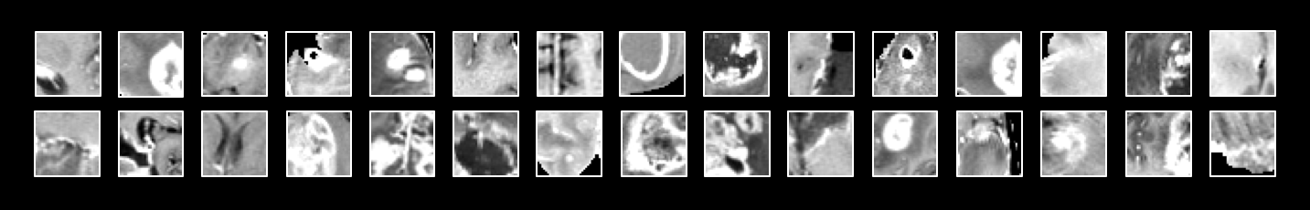 Examples of T1c patches used as input.