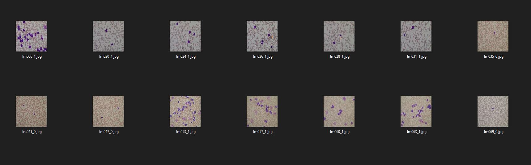 Acute Lymphoblastic Leukemia Arduino Nano 33 BLE Sense Classifier