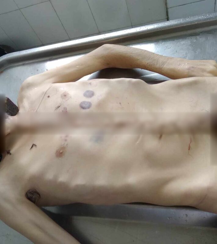 The malnourished cadaver of K. Hovhannisyan, a 40-year-old Armenian who died of starvation.