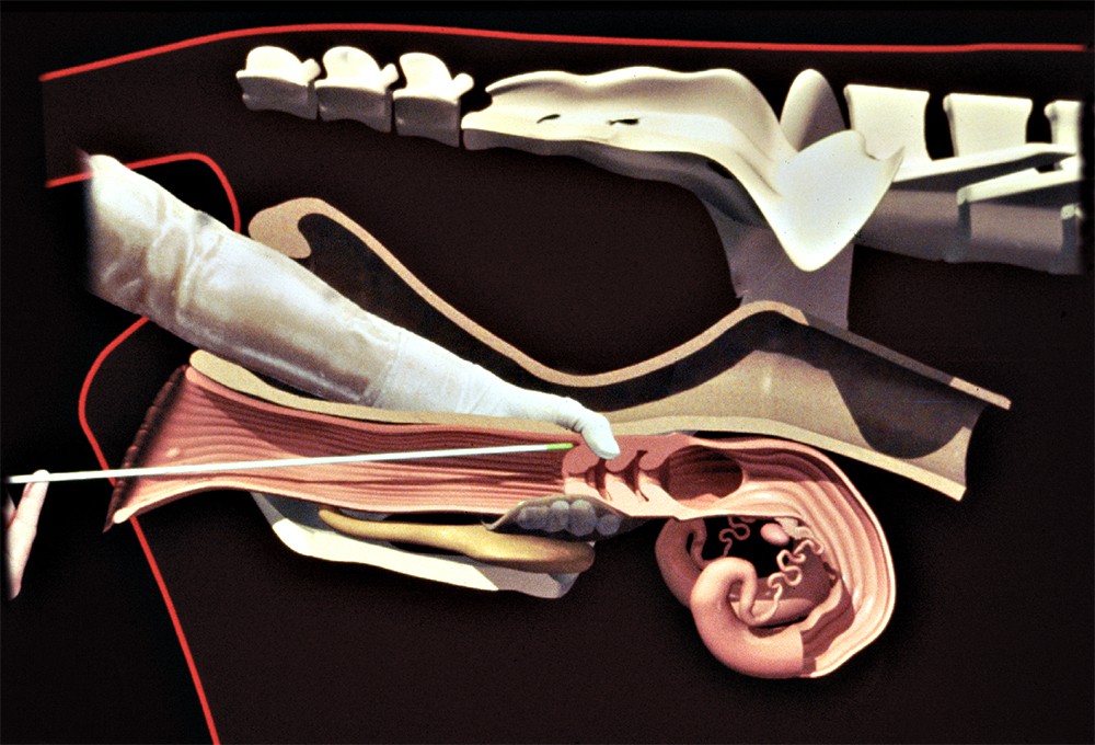 It is important to grasp the cervix and push it cranially to eliminate vaginal folds that often impede passage of the AI gun.