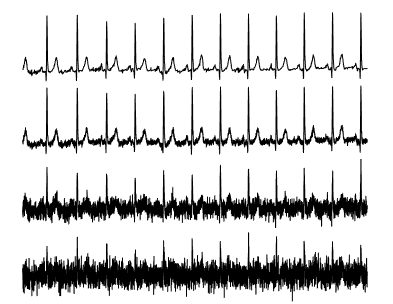 ECG with noise