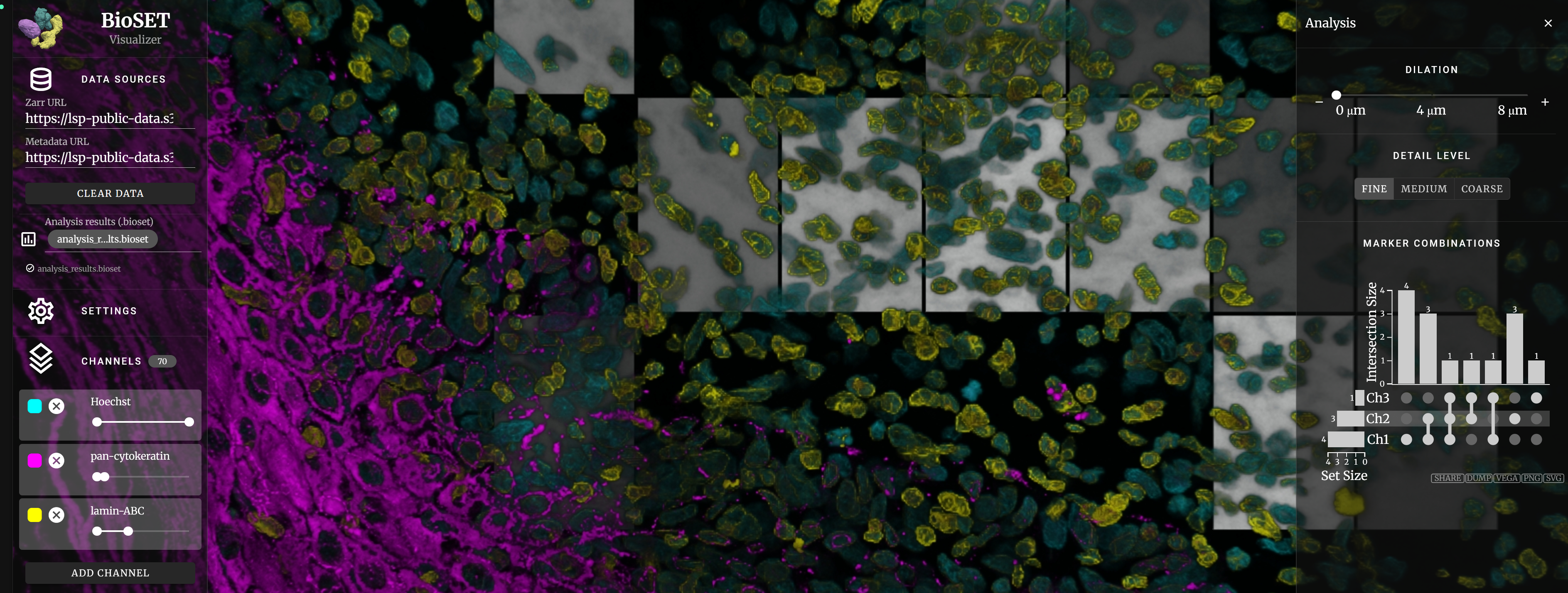 BioSET: Biomarker-based Spatial co-Expression analysis in Tumor environments