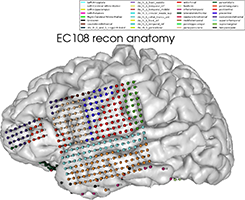 labeled electrodes on brain
