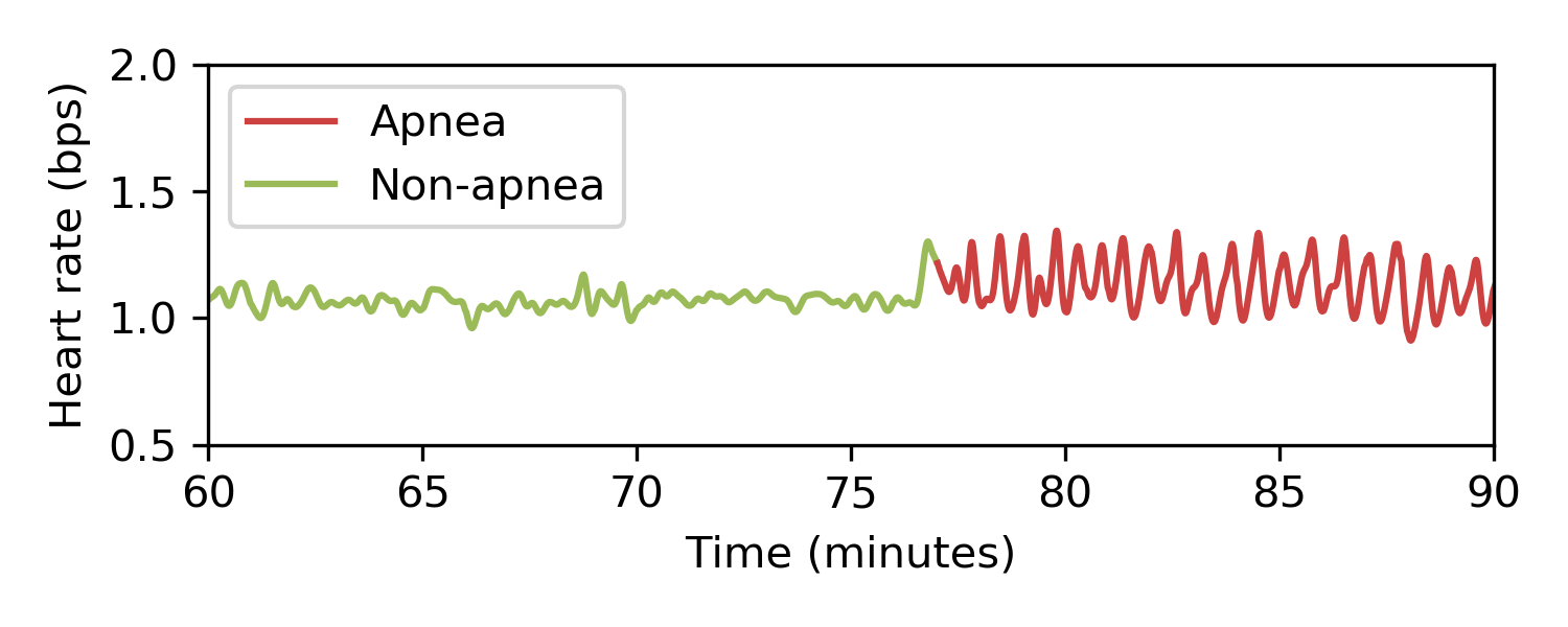 Apnea Ecg Detect Sleep Apnea Using Heart Rate Data From Wearable Devices