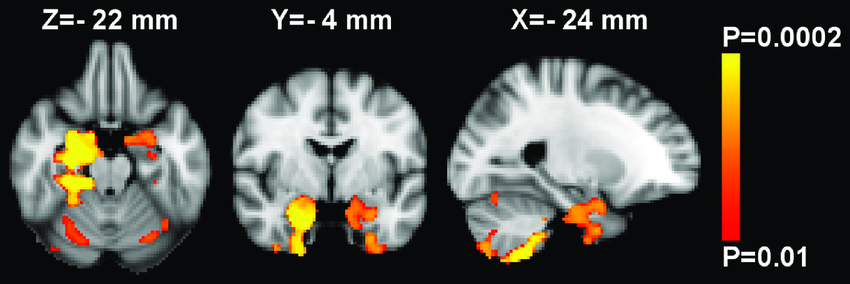 ENIGMA VBM L Hippocampus