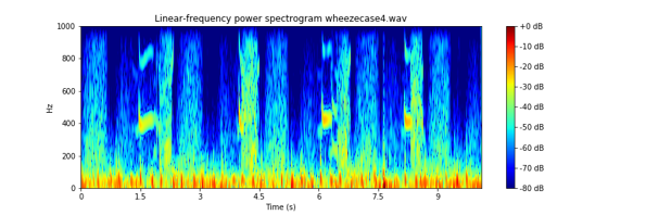 Audio Segmentation for Audio‑based Respiratory Anomaly Detection