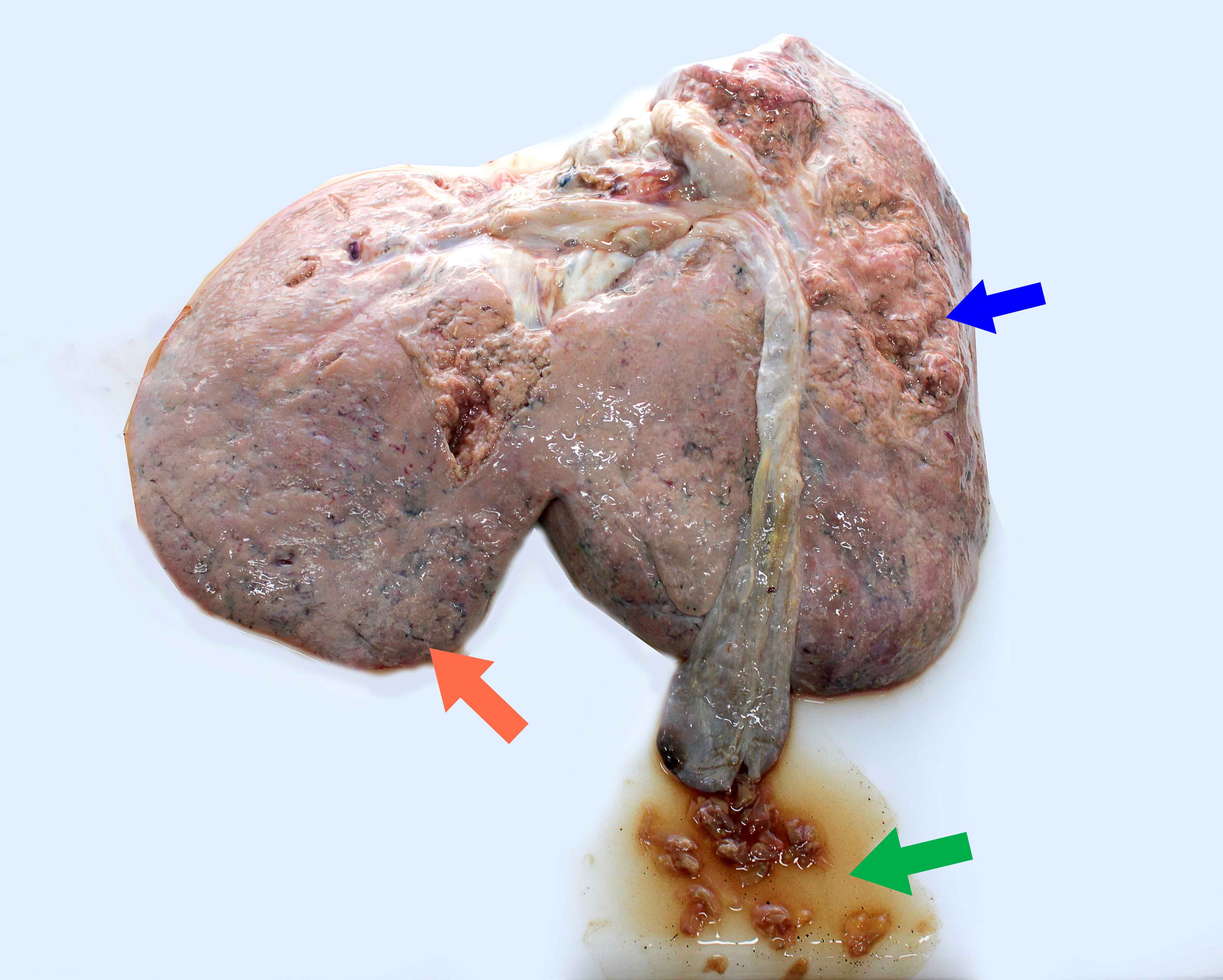 Photograph demonstrating characteristic lesions associated with acute faciolosis in the liver of a lamb. Note friable liver (blue arrow), subcapsular haemorrhagic tracts (orange arrow) and trematodes of Fasciola hepatica inside the gallbladder (green arrow).  Photo: Cosme Sánchez-Miguel.