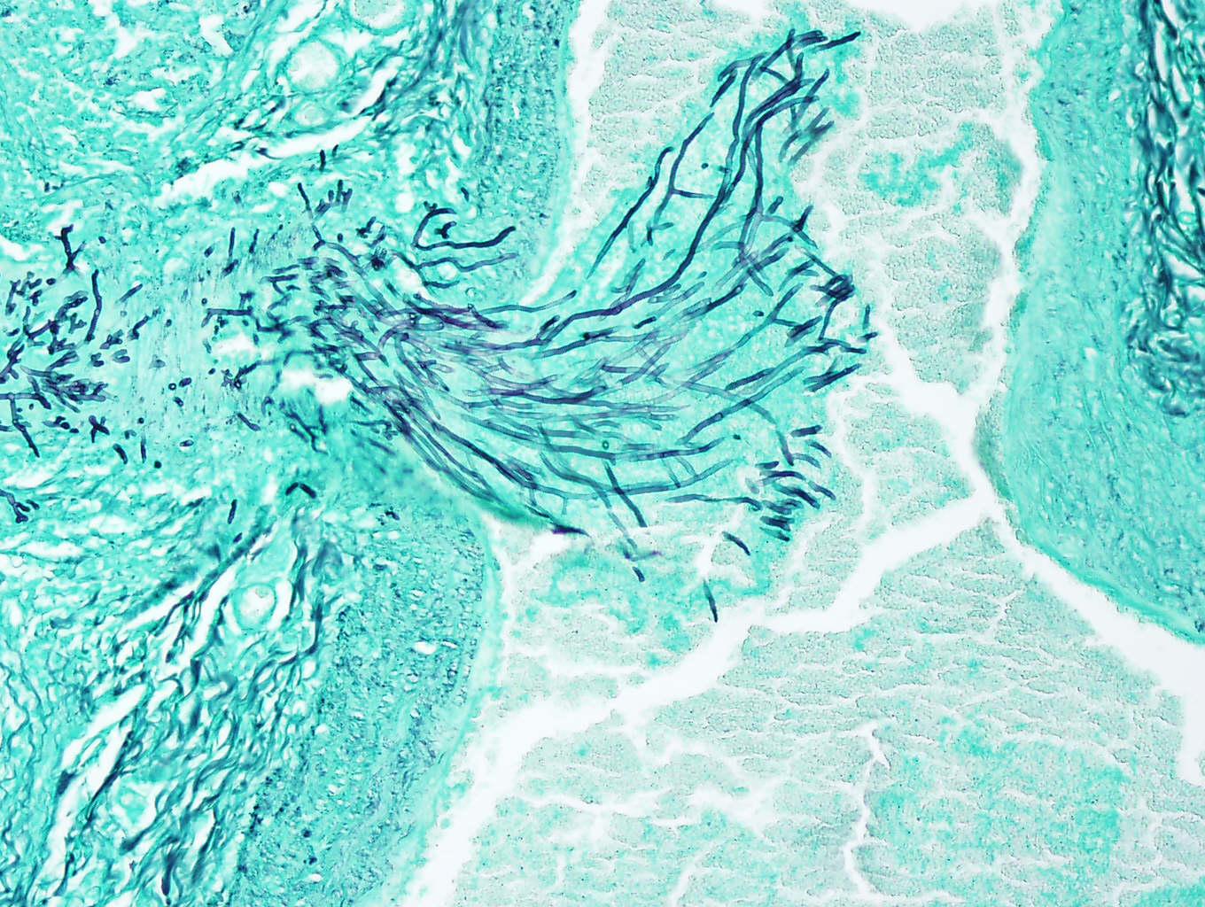 Angioinvasive: Aspergillus fumigatus invading through the endothelial cells of a blood vessel. Grocott's methenamine silver stain. Photo: Cosme Sánchez-Miguel.