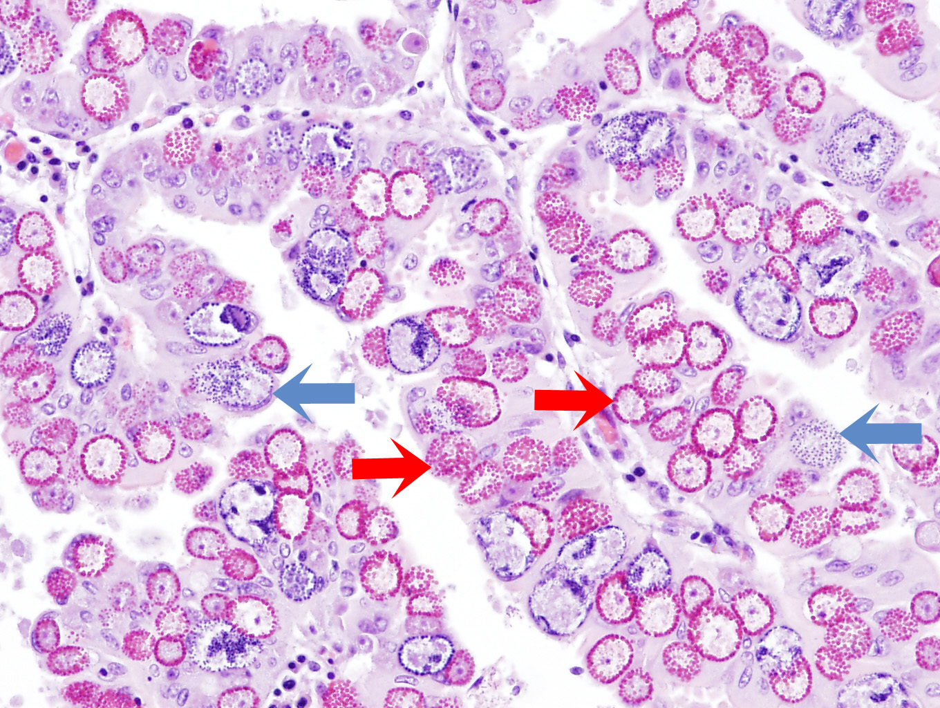 Coccidial microgamonts (blue arrow) and macrogamonts (red arrow) in the intestinal villi of an sheep with severe coccidiosis. Photo: Cosme Sánchez-Miguel.