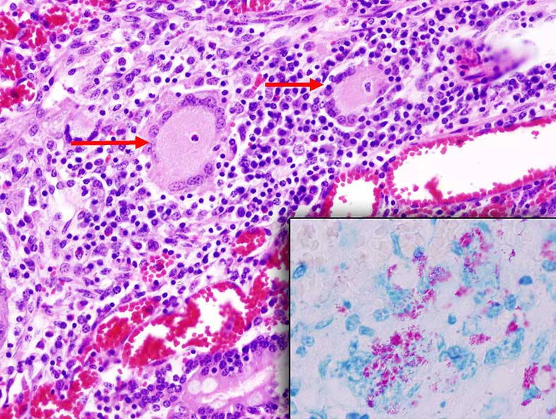 Microphotography of Langhan's-type giant cells (arrows) occasionally observed in tuberculoid granulomas seen in the lamina propia of the small intestine in animals with Johne's disease. Inset: Ziehl-Neelsen stained section showing acid-fast (Mycobacterium avium ssp. paratuberculosis bacilli). Photo: Cosme Sánchez-Miguel.