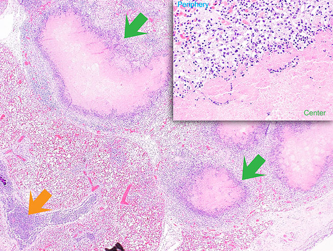 Bovine lung. Rounded foci of caseous necrosis (green arrow) surrounded by a rim of granulation tissue and centered around the airways in a calf with Mycoplasma bovis}. Photo: Cosme Sánchez-Miguel.