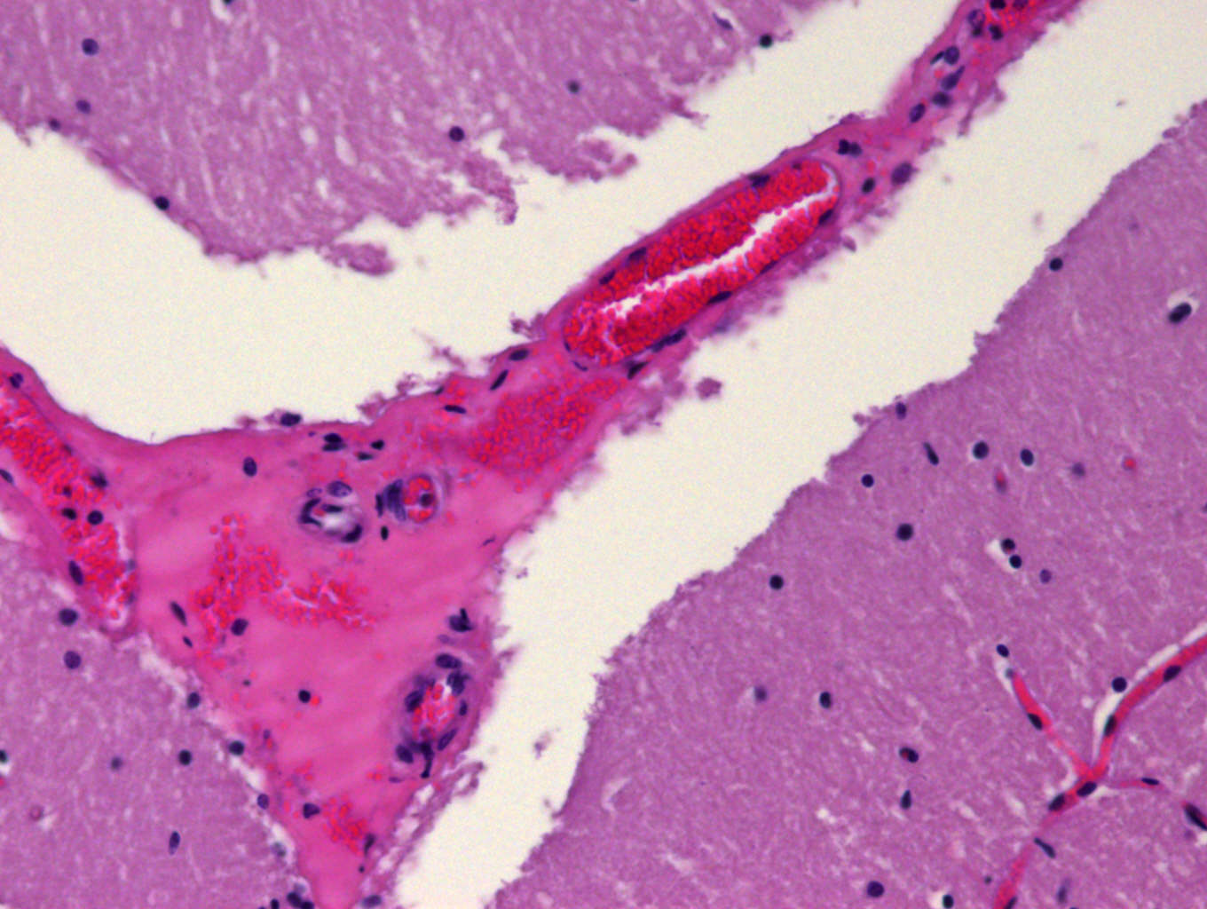 Perivascular oedema in the brain associated with vascular compromise due to Epsilon toxin-Pulpy kidney. Photo: Maresa Sheehan.