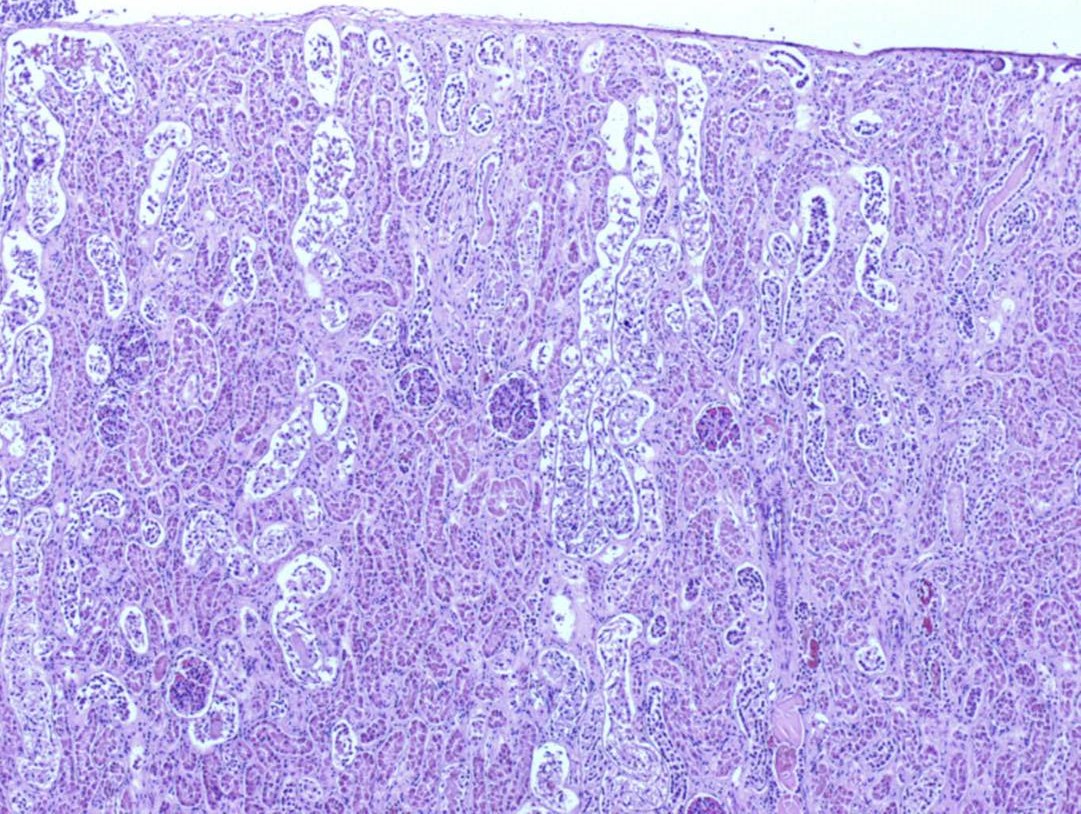 Lamb Kidney: Pulpy Kidney Disease: Severe acute proximal tubule necrosis and tubular protein casts. Clostrium perfringens epsilon toxin detected.  H\&E 10x magnification. Photo: Margaret Wilson.