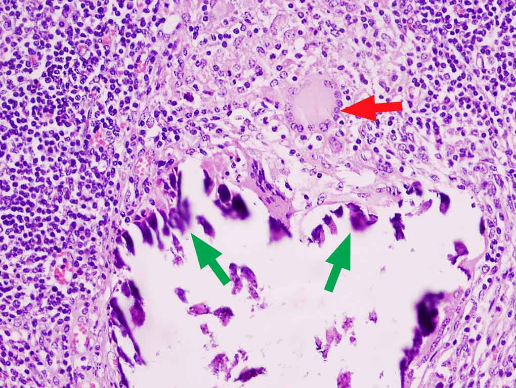 Chronic granulonatous inflammation. Langhan's multinucleated giant cell (red arrow) and dystrophic calcification (green arrows) due to necrosis in a TB granuloma. Photo: Cosme S\'anchez-Miguel.