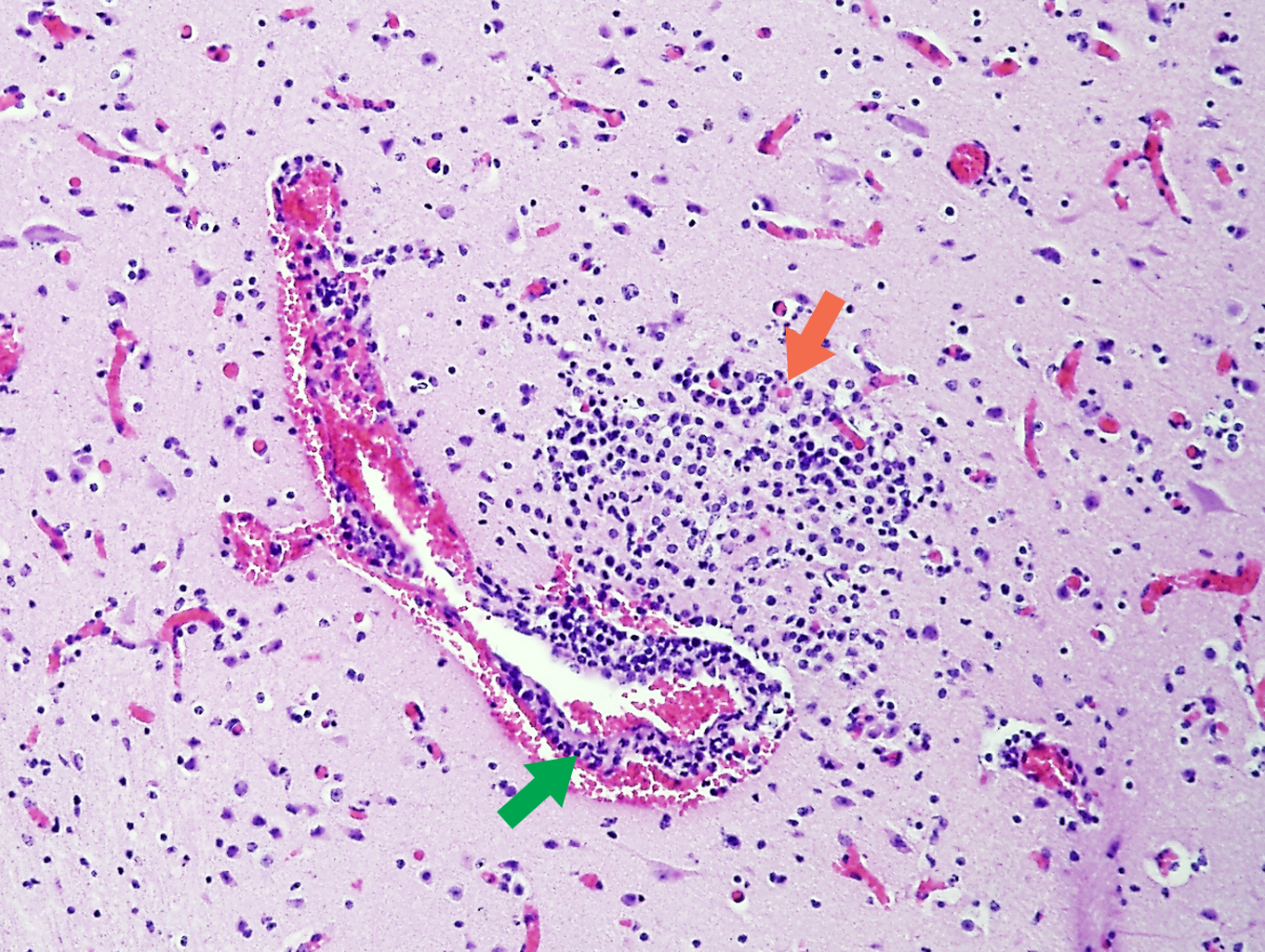 Protozoal encephalitis: non-suppurative encephalitis (orange arrow), mild vasculitis (green arrow) and congestion,  associated with Neospara caninum in the brain of a bovine foetus. Photo: Cosme Sánchez-Miguel.