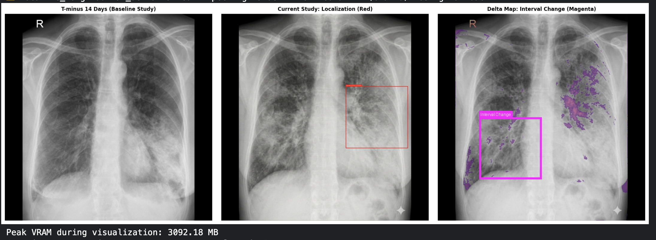 CXR baseline/localization/delta heatmap