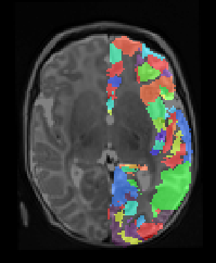 image/julich-brain-l-in-infant.png