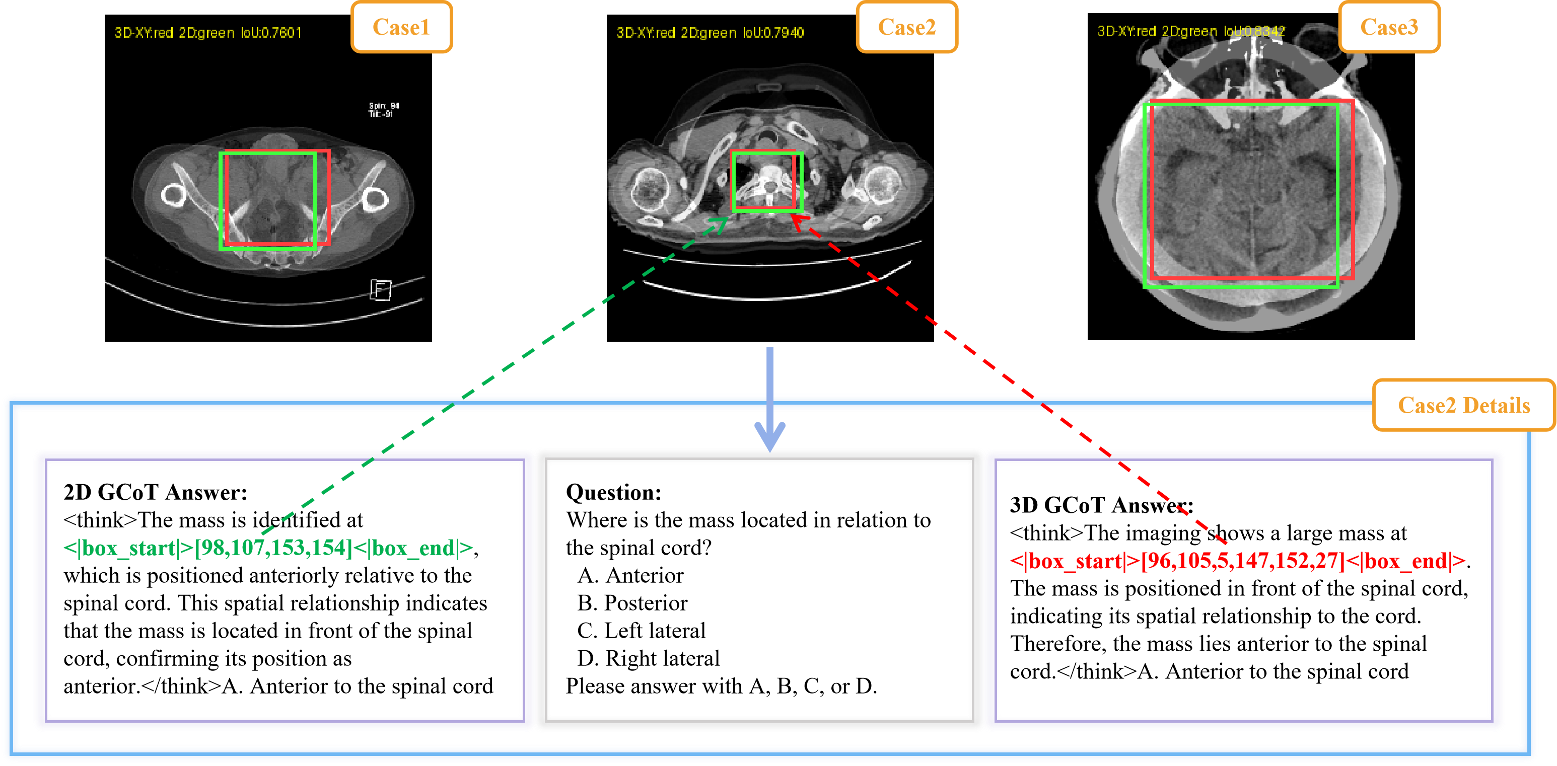 UniReason-Med grounding and IoU cases