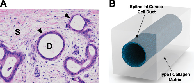 A Biomimetic Tumor Model of Heterogeneous Invasion in Pancreatic Ductal Adenocarcinoma