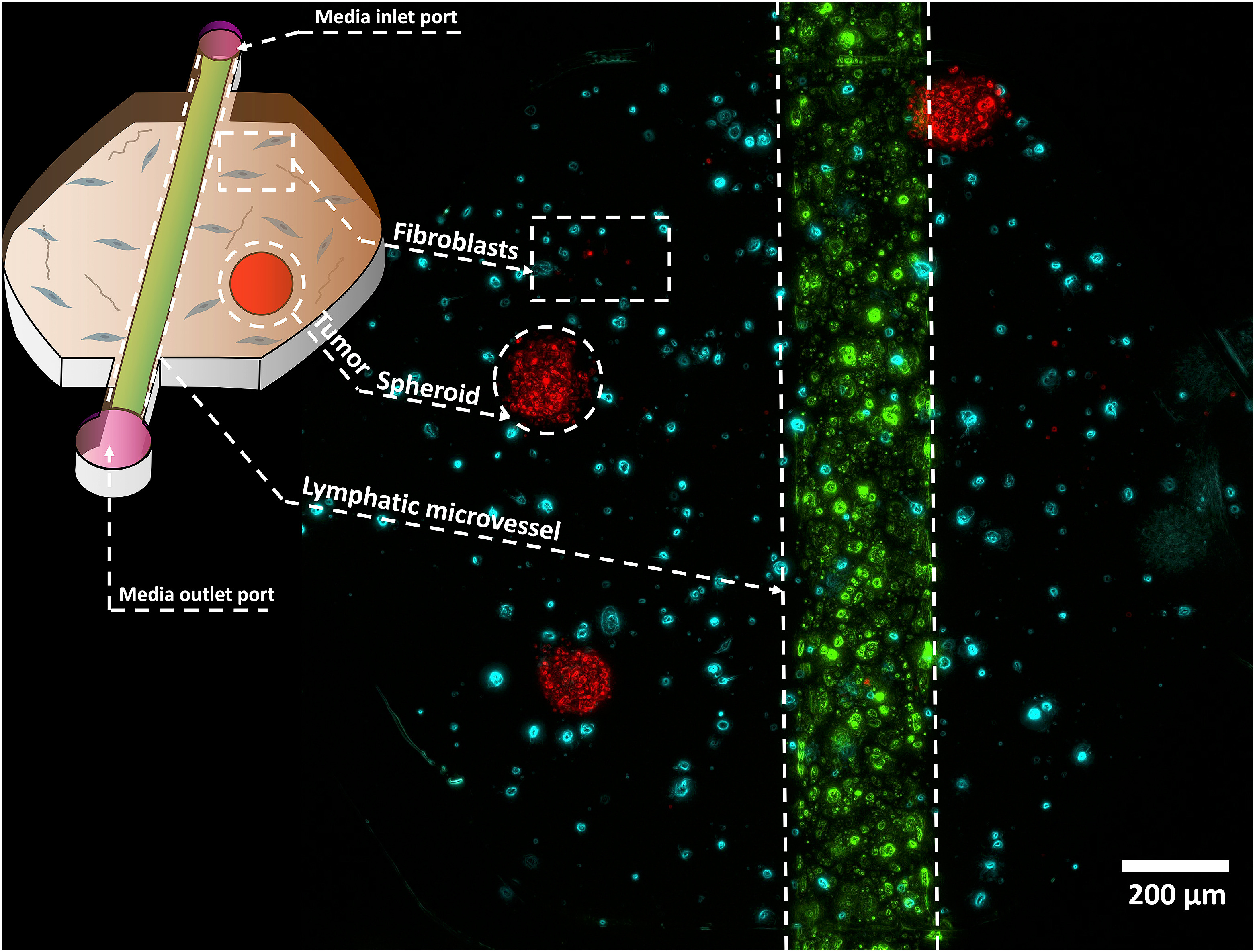 Microphysiological head and neck cancer model identifies novel role of lymphatically secreted monocyte migration inhibitory factor in cancer cell migration and metabolism