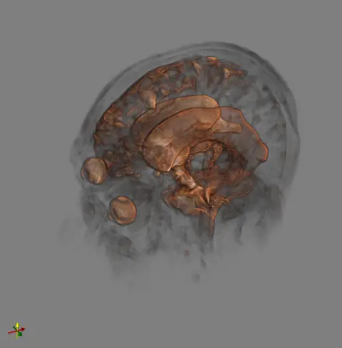 mri_ventricles