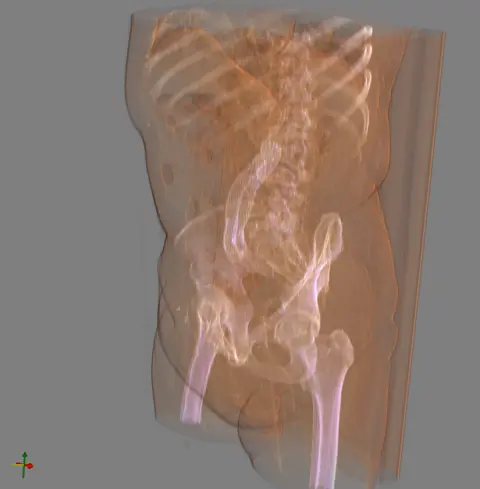 stent