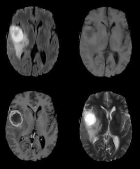 The four MRI sequences used in brain tumor segmentation: Flair, T1, T1-contrasted and T2
