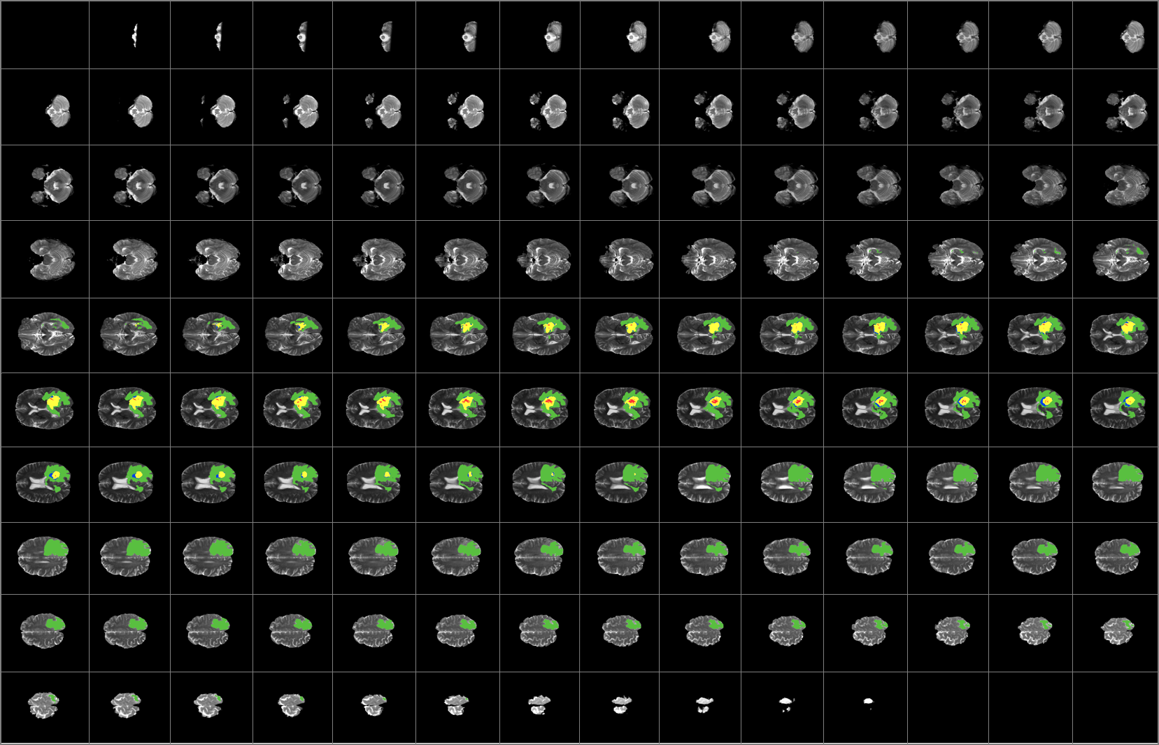 Results of the complete segmentation of a single brain
