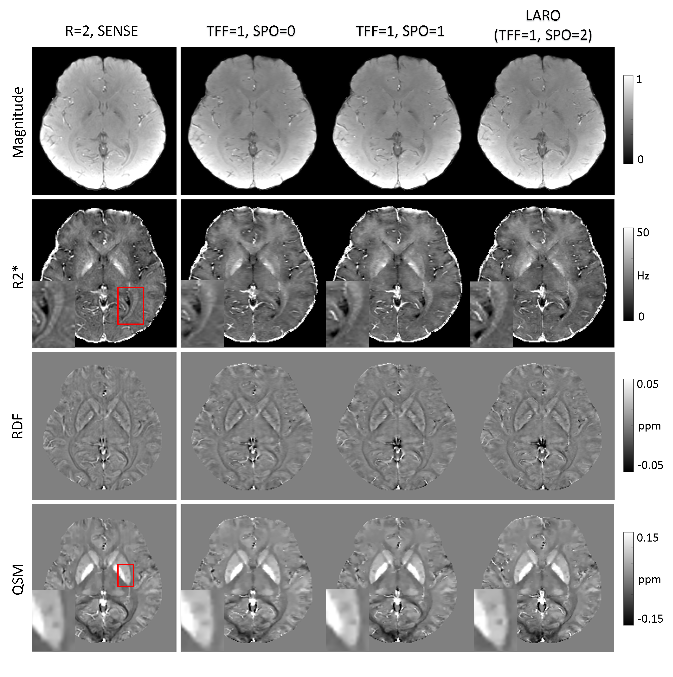 TFF reconstructions on prospectively under-sampled raw k-space data of one healthy subject with acceleration factor R=8.