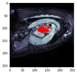 atrium-segmentation