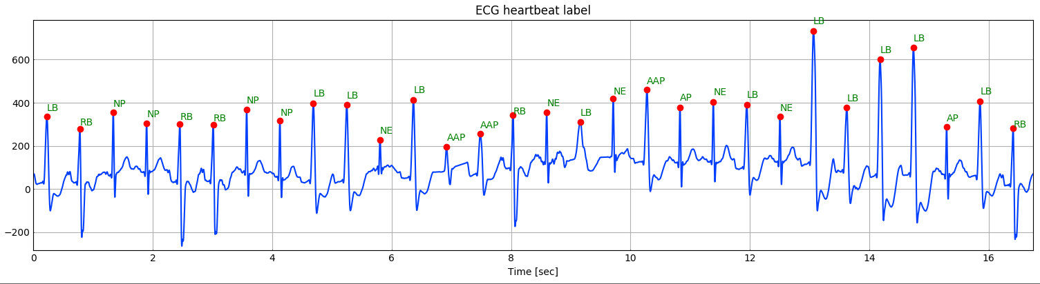 Abnormal heartbeat example