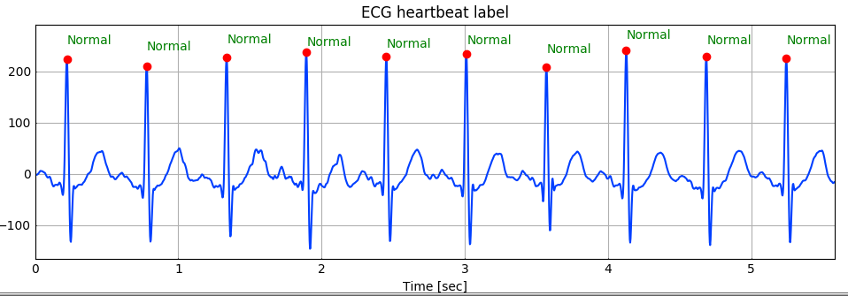 Normal heartbeat example