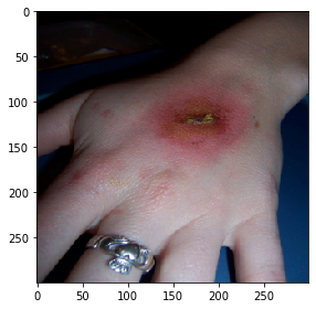 Infected Hand