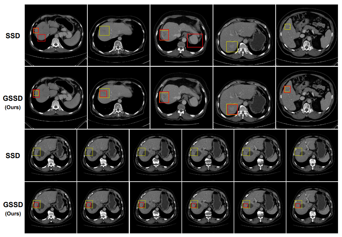 Liver Lesion Detection From Weakly-labeled Multi-phase CT Volumes With ...