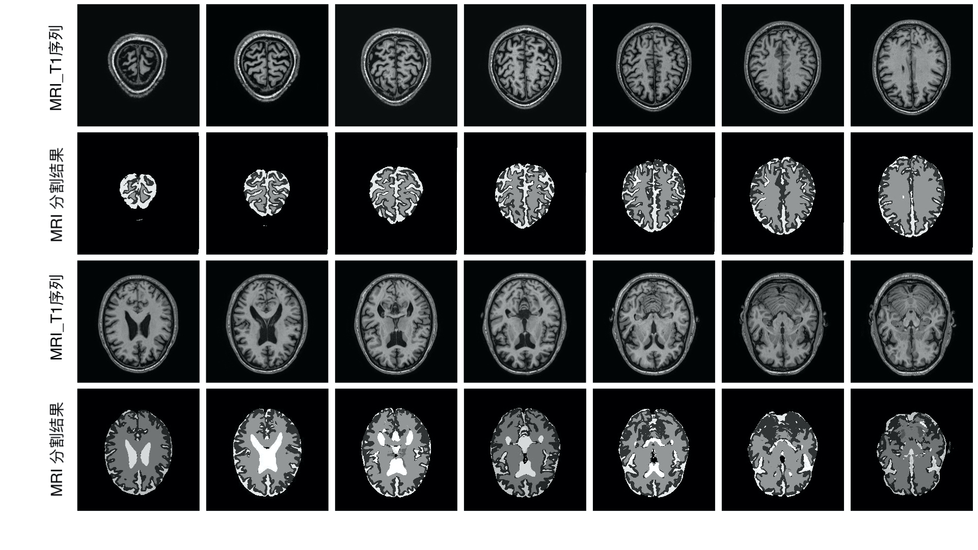 MRI Result