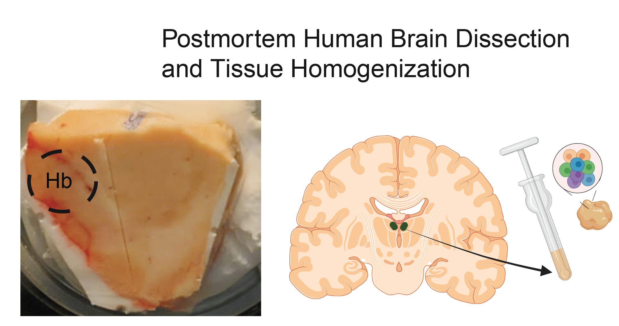 Habenula (Hb) postmortem human brain dissection.