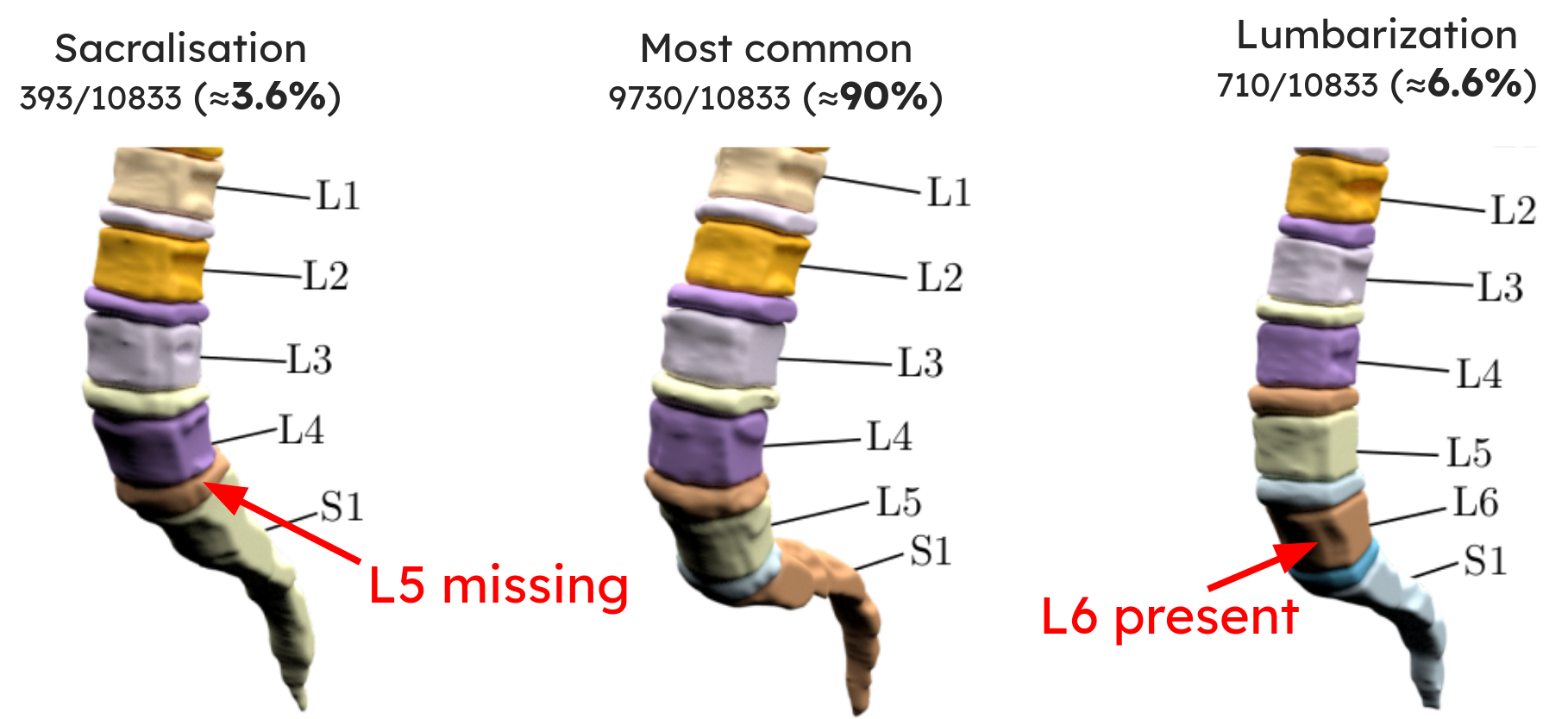 Sacralization and lumbarization prevalence