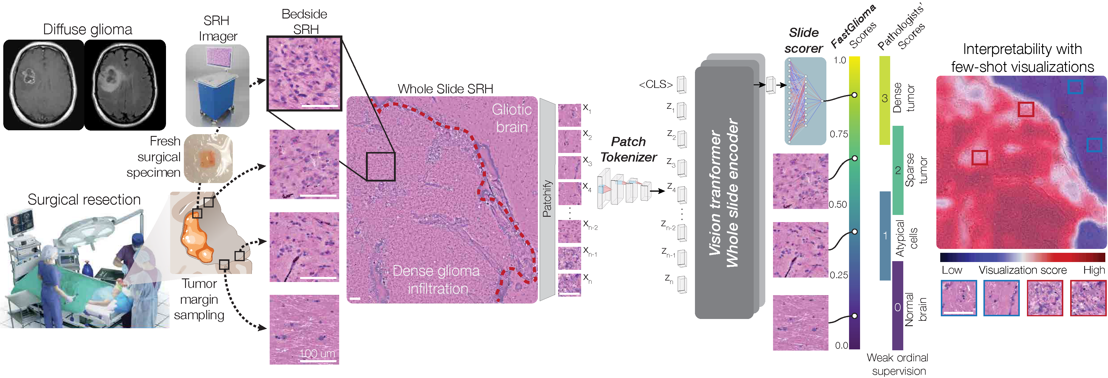 FastGlioma workflow: patient imaging, SRH acquisition, and AI analysis