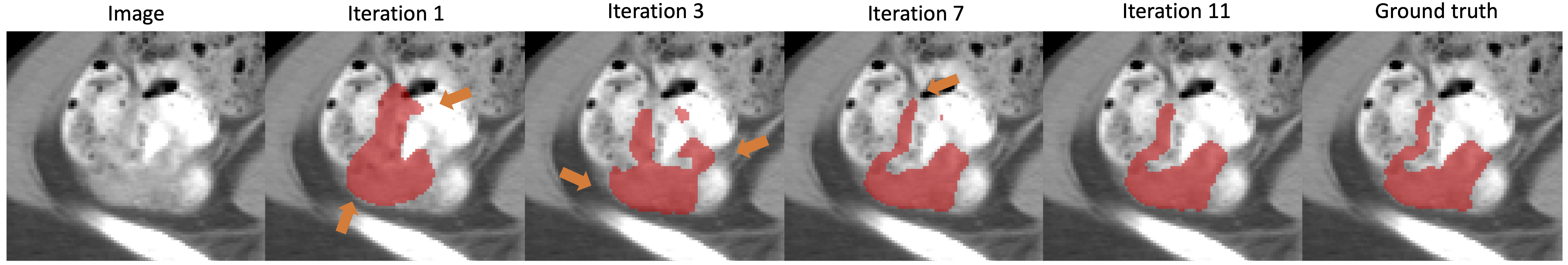 iterative_colon