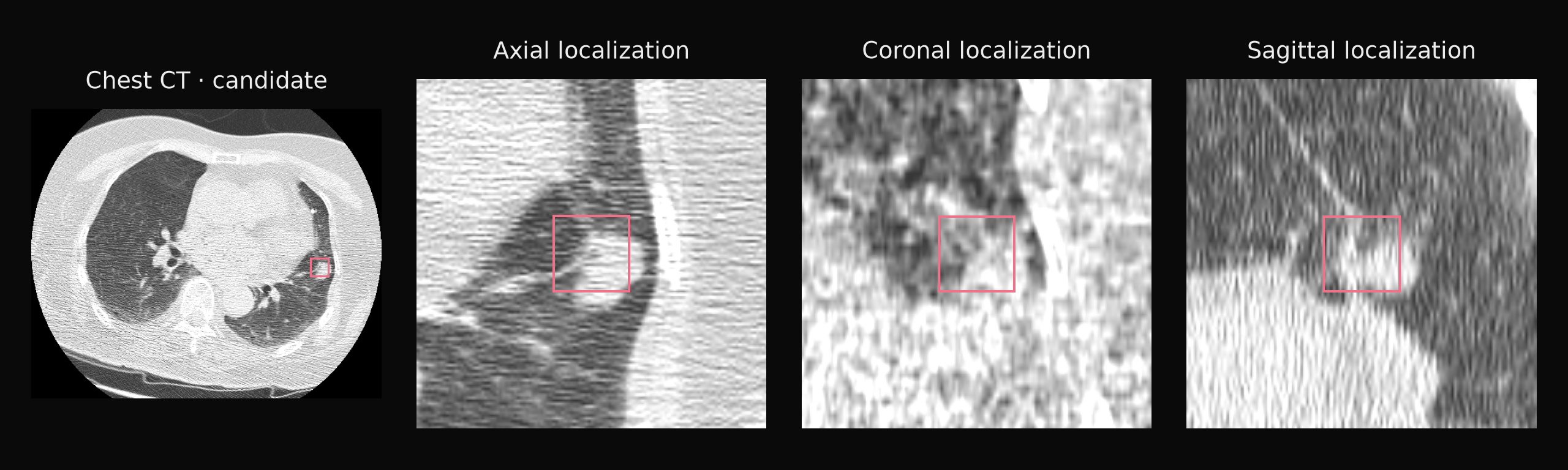 A 3D nodule candidate localized in axial, coronal and sagittal CT views.