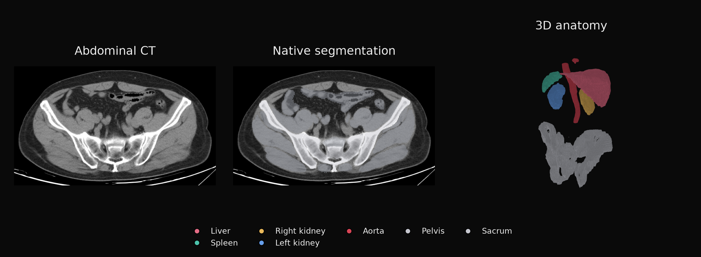 Automatic CT segmentation with selected organs and pelvic bones in 3D.