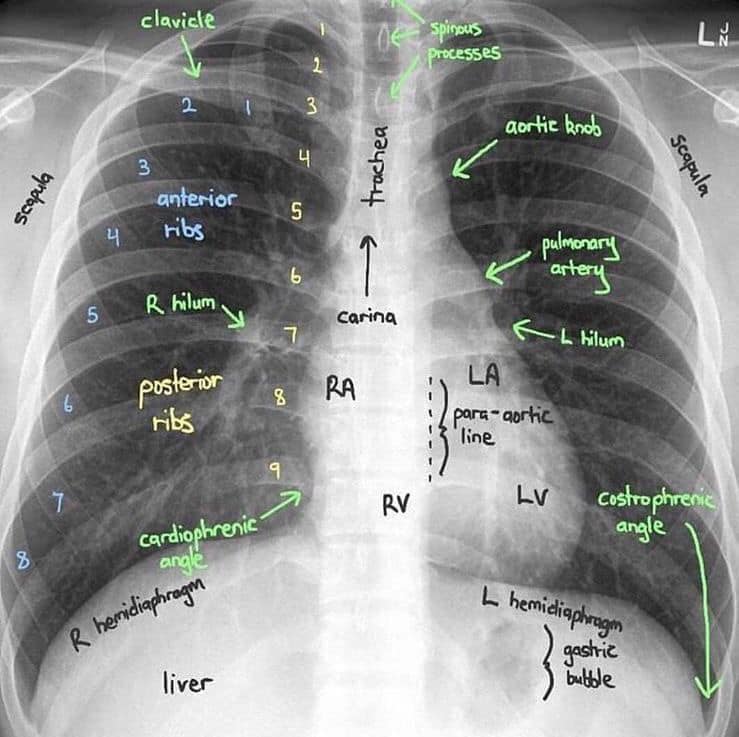 X-rays