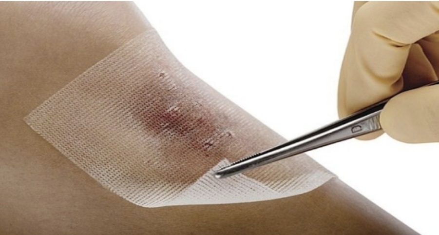 زخم پوش: Wound dressing