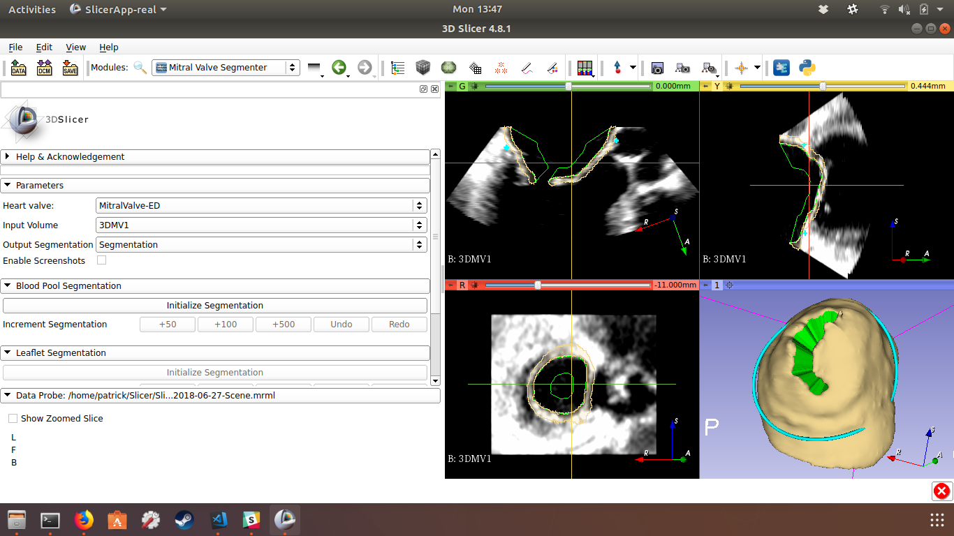 Mitral Valve Segmenter Module screenshot