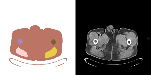 Generated CT and segmentation