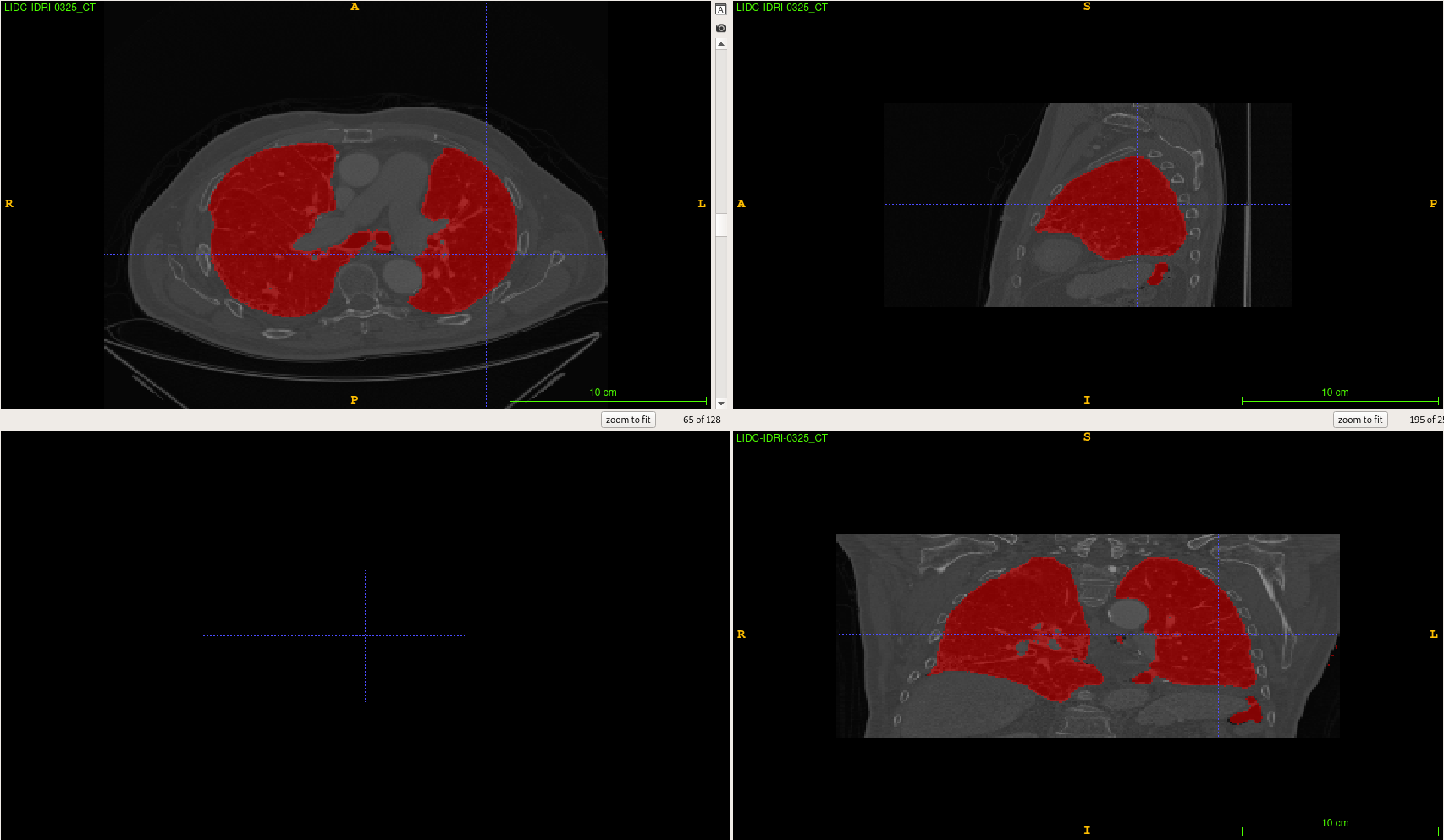 lung segmentation example