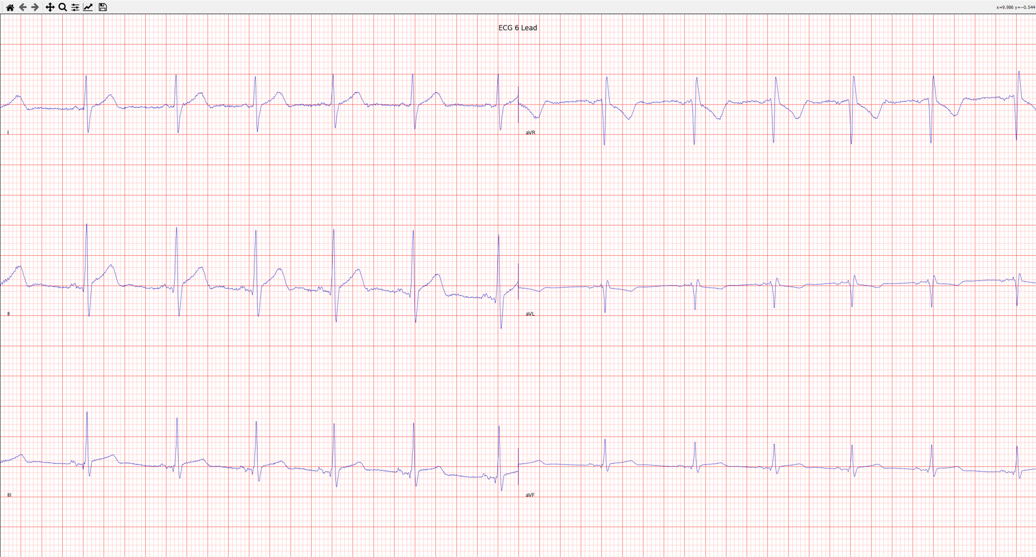 ECG Sample was taken at 533 Hz