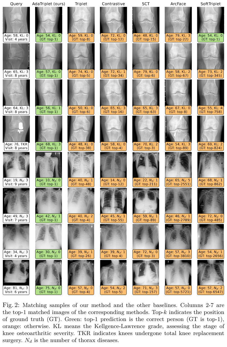 Results on CXR